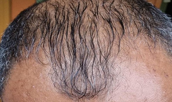   مصر اليوم - رئيس كوريا الجنوبية يثير الجدل بدعوته لتغطية علاجات الصلع ضمن التأمين الصحي العام باعتباره قضية تؤثر على حياة الشباب